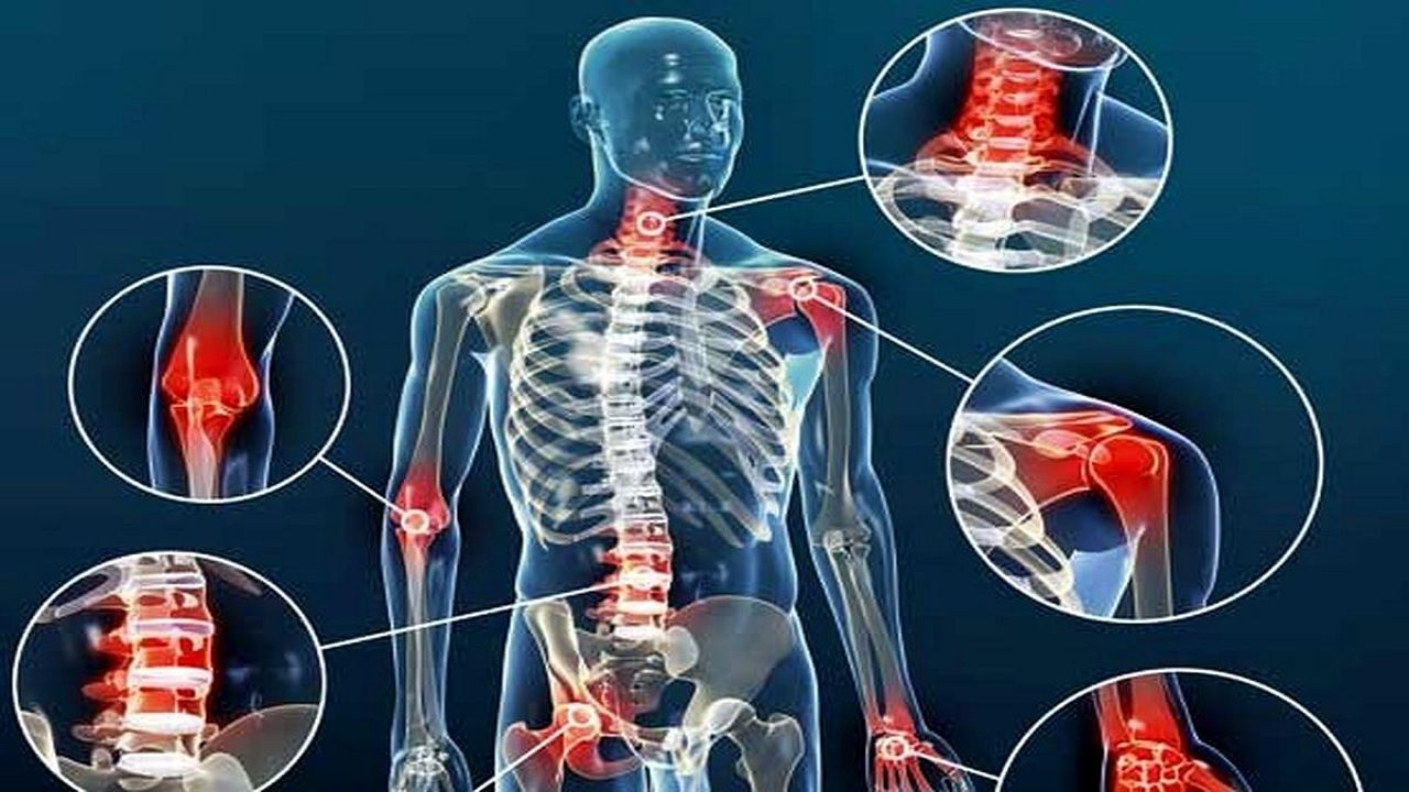 مواد غذایی که علائم آرتروز را تشدید میکنند