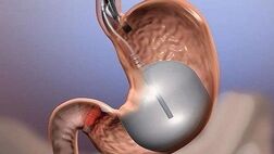 بهبود آسیب عصبی ناشی از دیابت با جراحی کاهش وزن