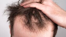 چرا با بالا رفتن سن، ریزش مو بیشتر می‌شود؟ + راهکارهای پیشگیری و درمان