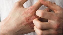 ۶ راهکار برای جلوگیری از خشکی پوست
